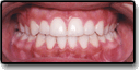 Crossbite After Photo