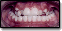 Crossbite Before Photo