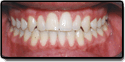 Crossbite After Picture