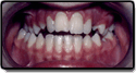 Crossbite Before Picture