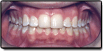 Crowding and Spacing Teeth - After