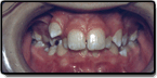 Crowding and Spacing Teeth - Before