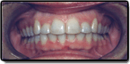Crowding and Spacing Teeth - After