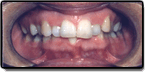 Crowding and Spacing Teeth - Before