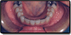 Crowding and Spacing Teeth - After