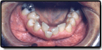 Crowding and Spacing Teeth - Before