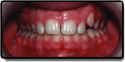 Impacted Tooth Before Photo