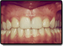 Missing Teeth after photo