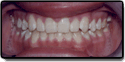 Overbite After Photo