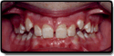 Overbite Before Photo