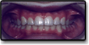 After Spacing of the Teeth