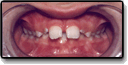 Before Spacing of the Teeth
