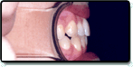 Underbite After Photo