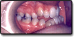 Underbite Before Photo